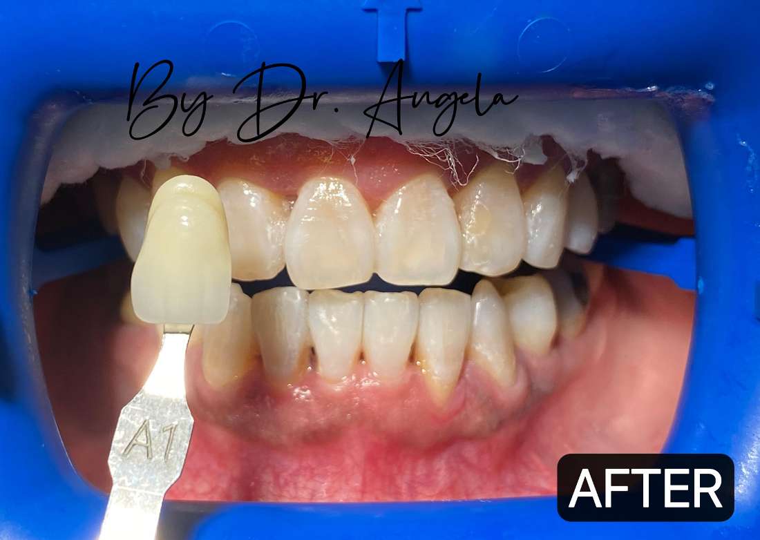 Teeth Whitening with PHILIPS ZOOM Before & After Photos Haymarket NSW
