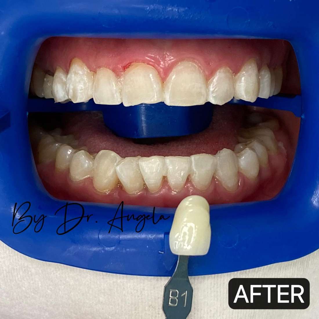 Teeth Whitening with PHILIPS ZOOM Before & After Photos Haymarket NSW