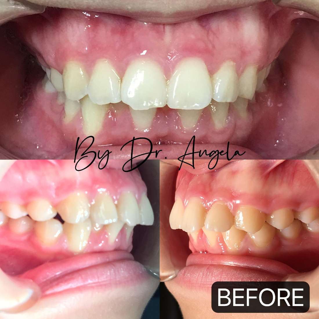 16 months of Invisalign Treatment with Extraction Before & After Photos