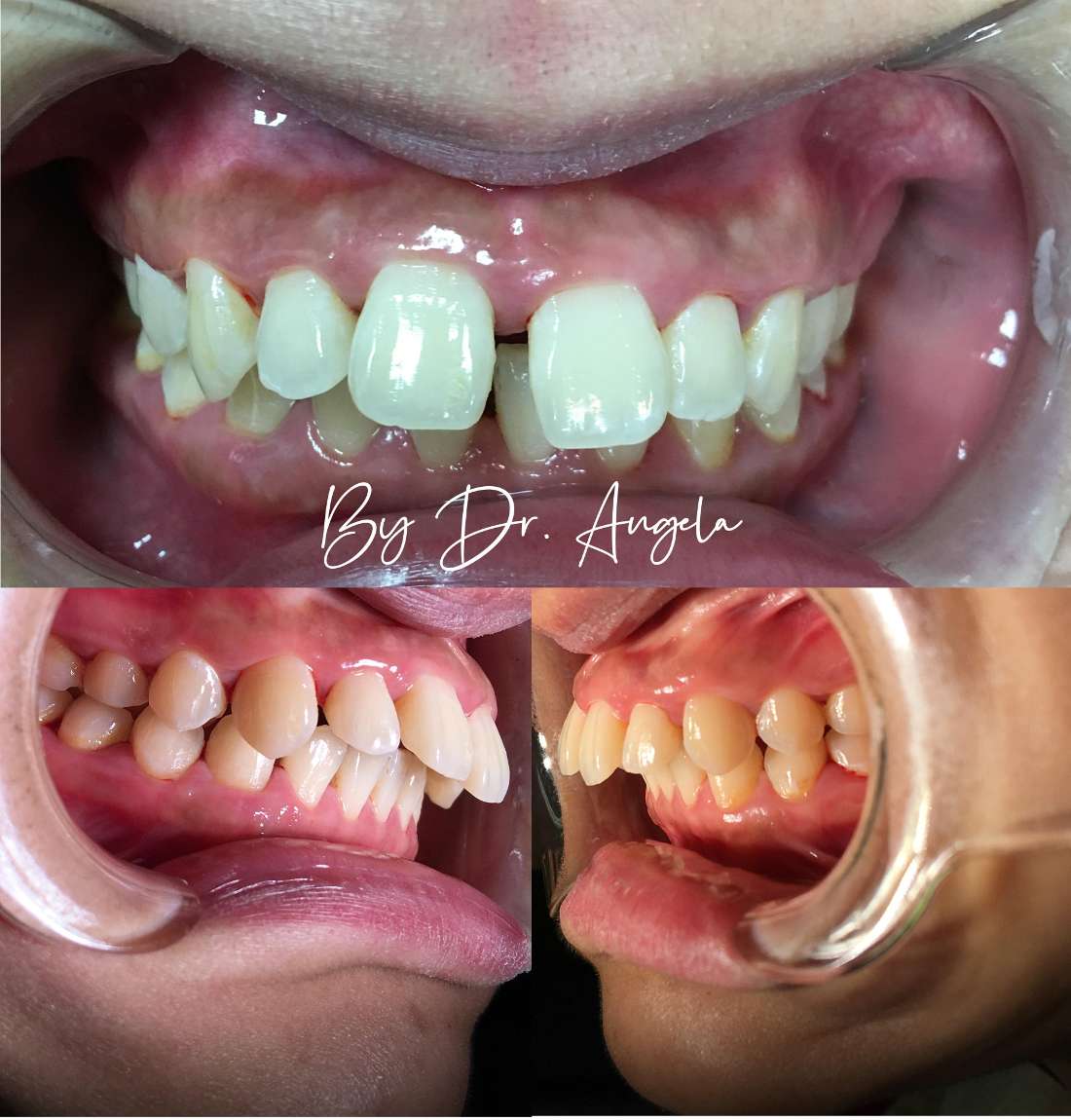 18 Months Of Invisalign Treatment Before & After Photos