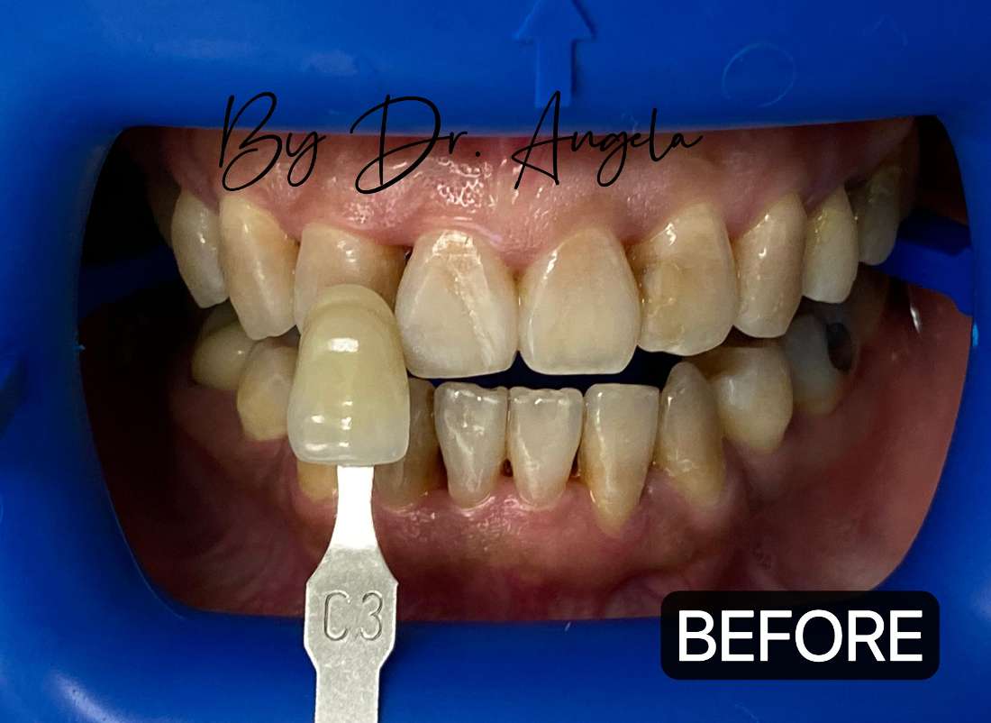 Teeth Whitening with PHILIPS ZOOM Before & After Photos Haymarket NSW