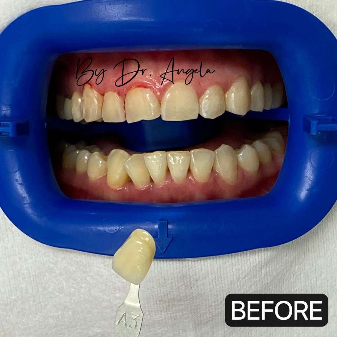 Teeth Whitening with PHILIPS ZOOM Before & After Photos Haymarket NSW