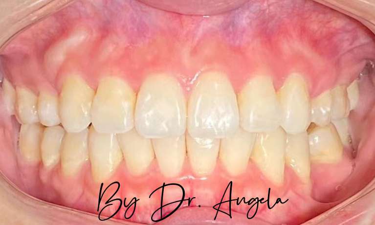 16-Months-of-Invisalign-Treatment-After-Image