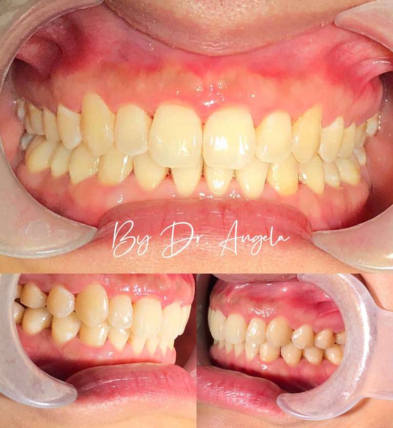 18-Months-Of-Invisalign-Treatment-After-Image