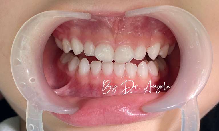 AIRFLOW-Dental-Spa-Treatment-on-Kid-After-Image