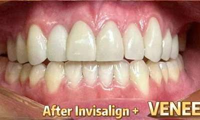 Porcelain-Veneers-After-Image