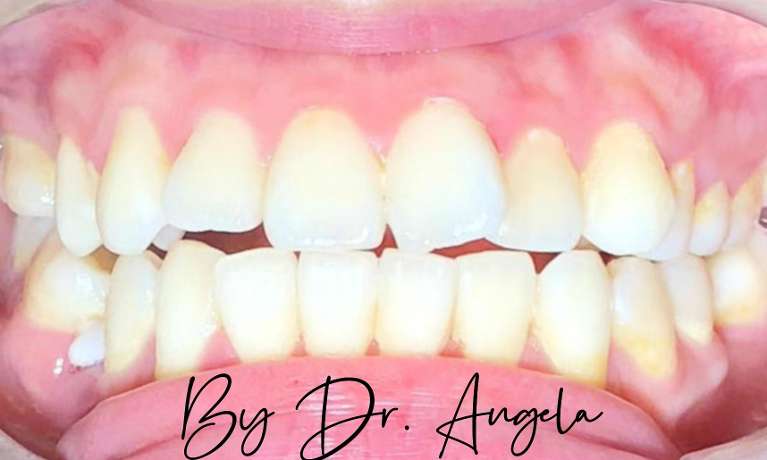 16-Months-of-Invisalign-Treatment-Before-Image