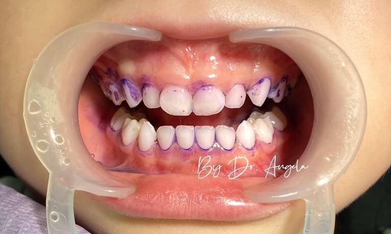 AIRFLOW-Dental-Spa-Treatment-on-Kid-Before-Image