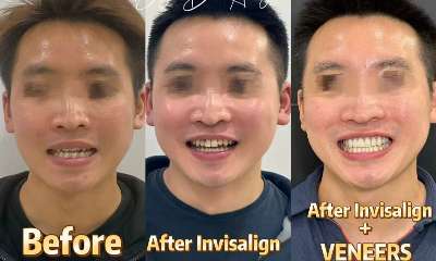 Porcelain-Veneers-Before-Image